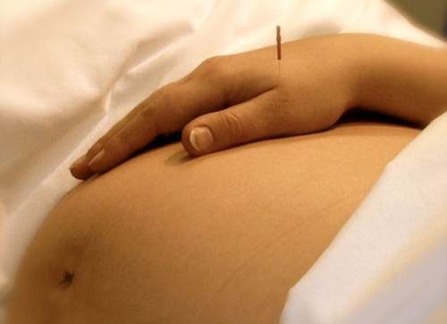 Hamilelikte Akupunktur Nedir? Akupunkturun Faydaları Nelerdir?